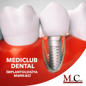 MediClub Dental-da diş implantasiyası